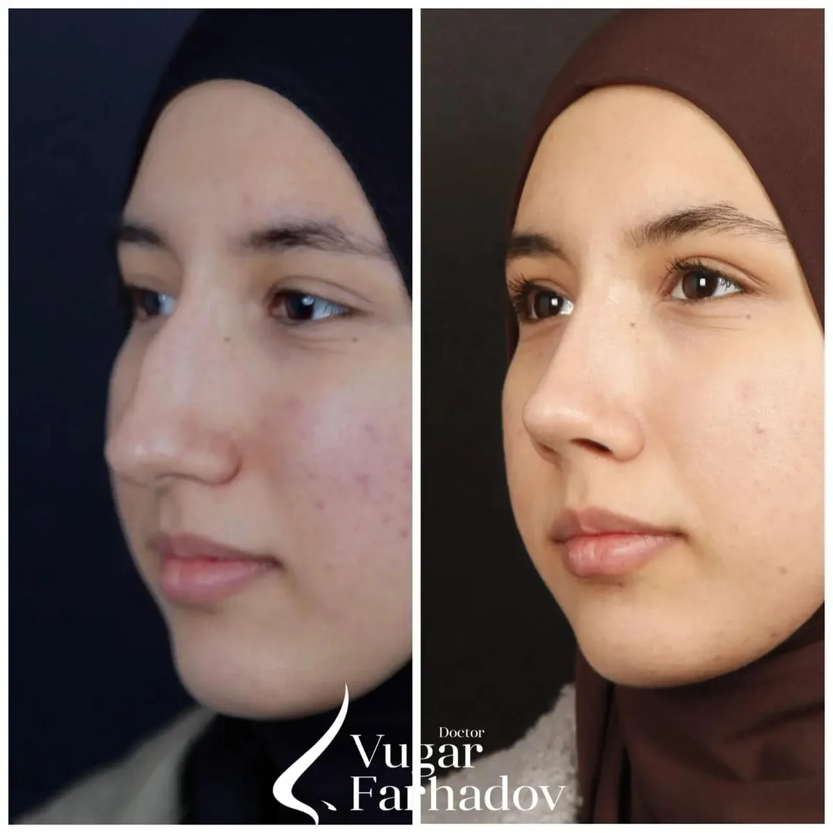 Vüqar Fərhadov — قبل / بعد - زاوية 2