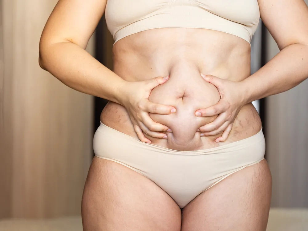 Abdominoplastika: Doğuşdan və ya çəki itkisindən sonra qarın bərpası