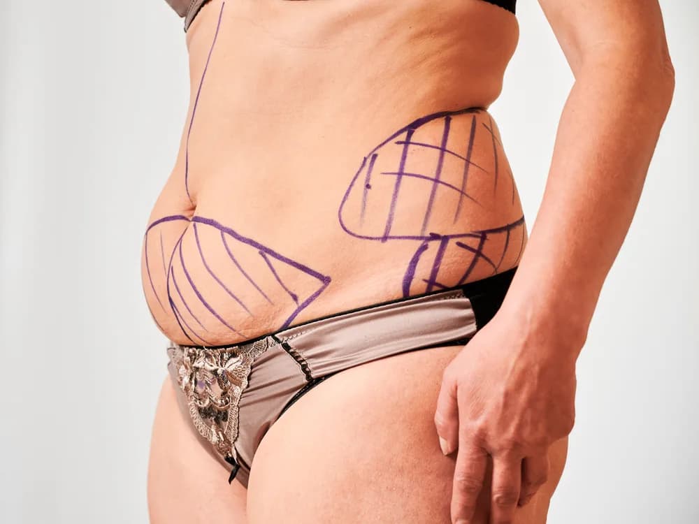 Abdominoplastika