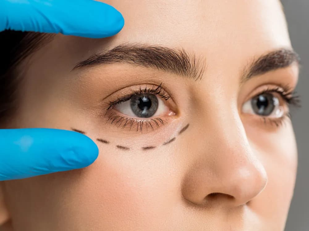 Blefaroplastika