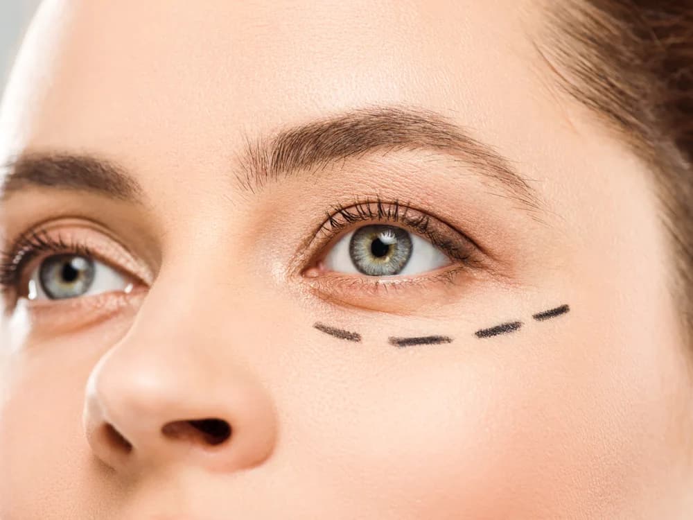Under-eye bags and dark circles: what causes them, and when is surgery needed?
