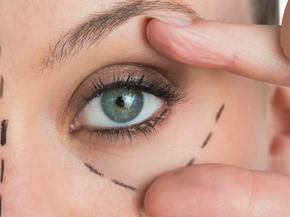 Blefaroplastika