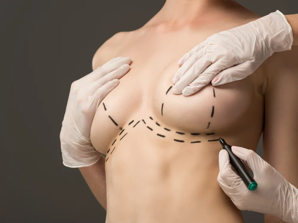 Mammoplastika sonrası ilk 6 həftə: gün-gün bərpa cədvəli