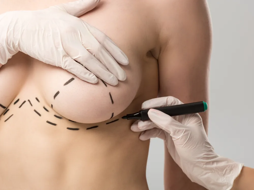 Mammoplastika