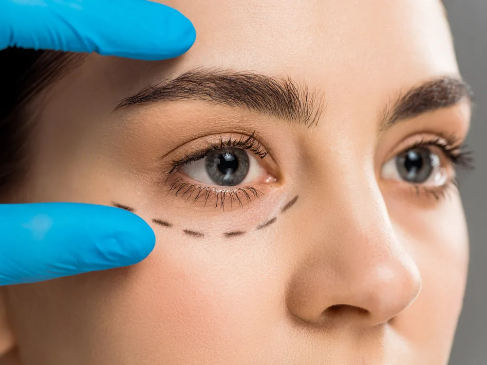 Blefaroplastika
